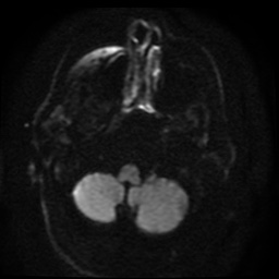 Cerebral embolic infarcts (embolic shower) (Radiopaedia 49837-55108 Axial DWI 90).jpg
