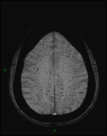 Cerebral fat embolism (Radiopaedia 35022-36525 Axial SWI 41).jpg