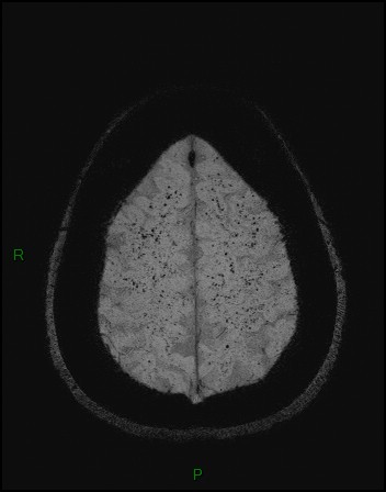 Cerebral fat embolism (Radiopaedia 35022-36525 Axial SWI 51).jpg