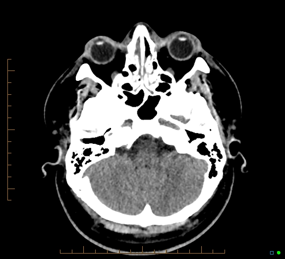 Cerebral fat embolism (Radiopaedia 85521-101224 Axial non-contrast 11).jpg