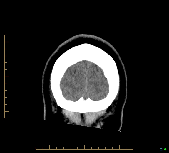 Cerebral fat embolism (Radiopaedia 85521-101224 Coronal non-contrast 59).jpg