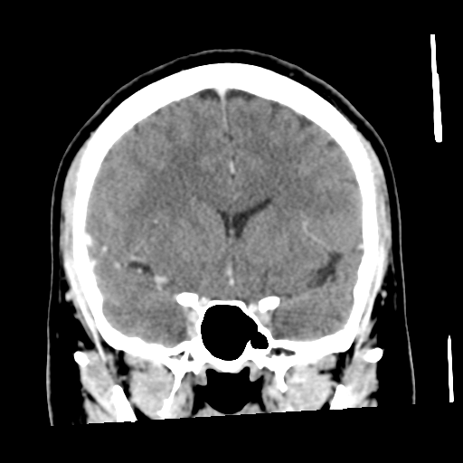 Cerebral hemorrhage secondary to arteriovenous malformation (Radiopaedia 33497-34561 C 26).png