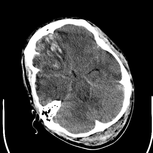 File:Cerebral hemorrhagic contusions- temporal evolution (Radiopaedia 40224-42752 Axial non-contrast 8).png
