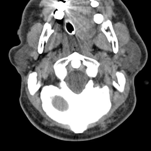 Cerebral hemorrhagic contusions and cervical spine fractures (Radiopaedia 32865-33841 F 11).jpg