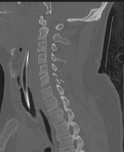Cerebral hemorrhagic contusions and cervical spine fractures (Radiopaedia 32865-33841 Sagittal bone window 46).jpg