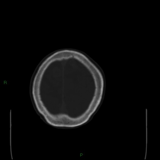 Cerebral metastases - breast primary (Radiopaedia 77653-89857 Axial bone window 103).jpg