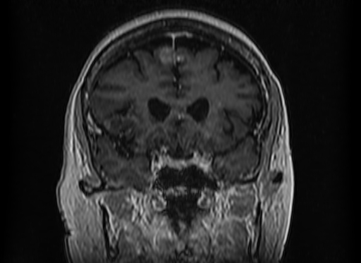 File:Cerebral metastases from lung cancer with amyloid angiopathy and cerebellopontine angle meningioma (Radiopaedia 74306-85191 Coronal T1 C+ 20).jpg