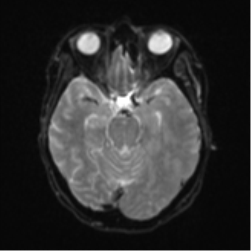 Cerebral metastasis (Radiopaedia 46744-51248 Axial DWI 10).png