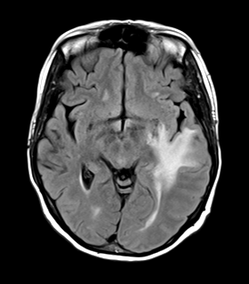 File:Cerebral metastasis (Radiopaedia 46744-51248 Axial FLAIR 12).png