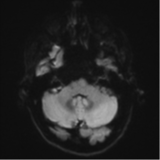 Cerebral metastasis - melanoma (Radiopaedia 54718-60954 Axial DWI 38).png