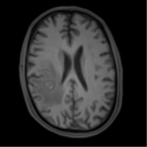 Cerebral metastasis - melanoma (Radiopaedia 54718-60954 Axial T1 33).png