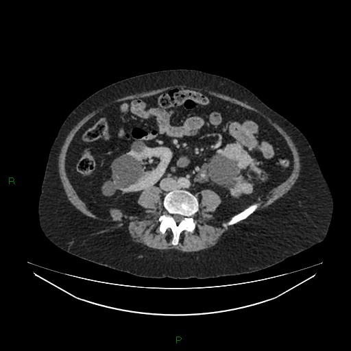 Cerebral metastasis from renal cell carcinoma (Radiopaedia 82306-96378 A 107).jpg