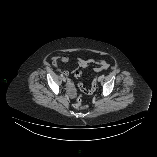 Cerebral metastasis from renal cell carcinoma (Radiopaedia 82306-96378 A 162).jpg