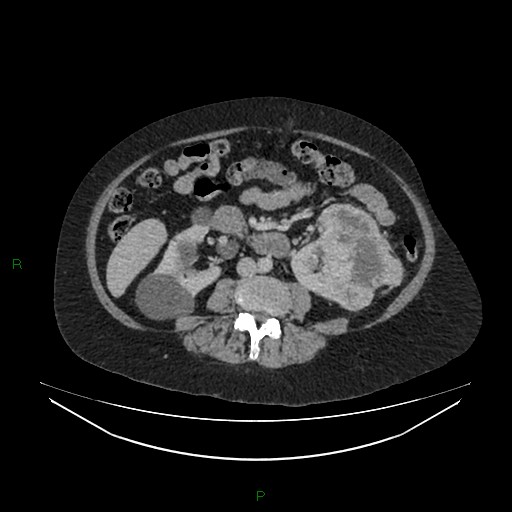 File:Cerebral metastasis from renal cell carcinoma (Radiopaedia 82306-96378 A 93).jpg