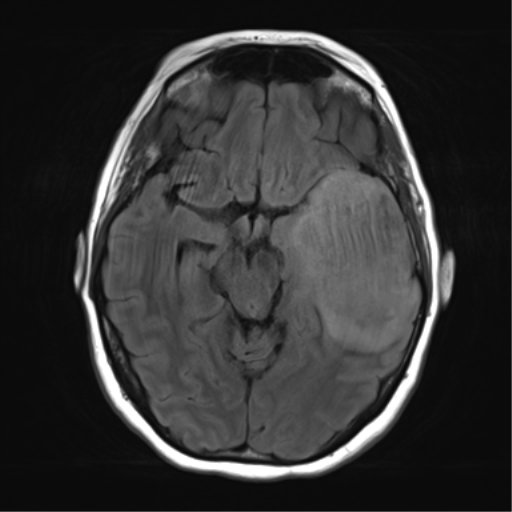 File:Cerebral metastasis mimicking glioblastoma (Radiopaedia 69155-78937 Axial FLAIR 14).png