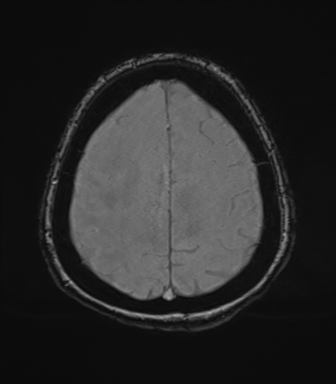 Cerebral metastasis to basal ganglia (Radiopaedia 81568-95413 Axial SWI magnitude 71).png