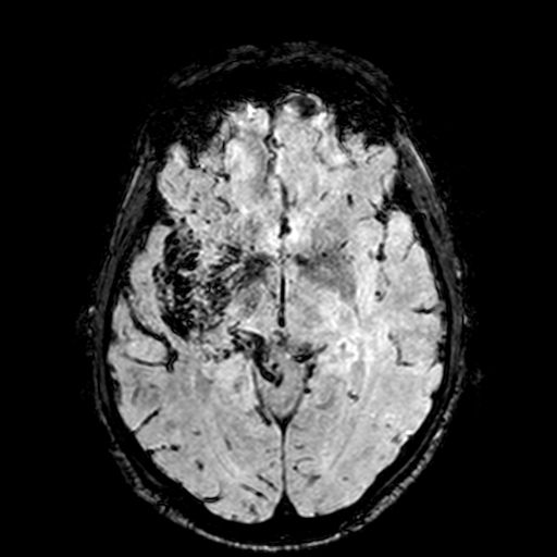 Cerebral parenchymal arteriovenous malformation (Radiopaedia 27280-27456 Axial SWI 50).jpg