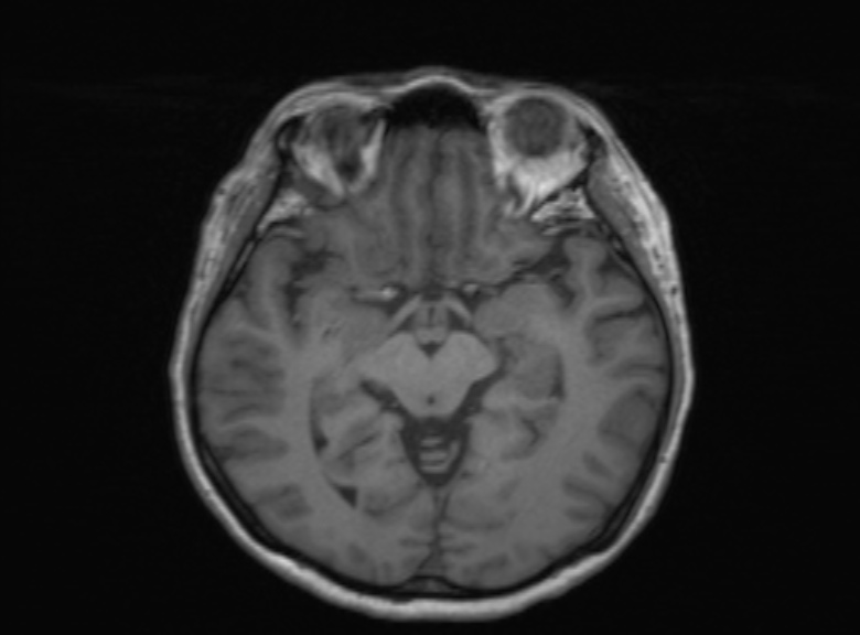 Cerebral ring enhancing lesions - cerebral metastases (Radiopaedia 44922-48817 Axial T1 250).jpg