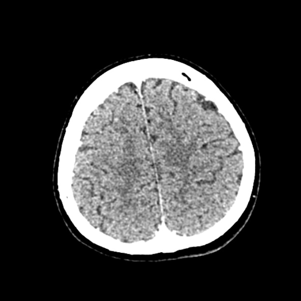Cerebral ring enhancing lesions - cerebral metastases (Radiopaedia 44922-48818 B 226).jpg