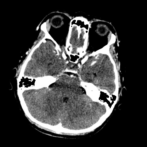 Cerebral tuberculosis with dural sinus invasion (Radiopaedia 60353-68019 Axial C+ delayed 18).jpg