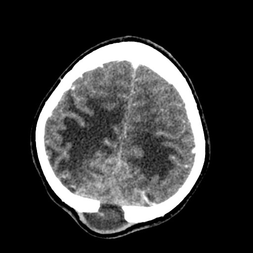 Cerebral tuberculosis with dural sinus invasion (Radiopaedia 60353-68019 Axial C+ delayed 54).jpg