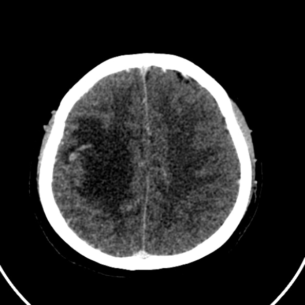 File:Cerebral venous hemorrhagic infarct from venous sinus thrombosis (Radiopaedia 55433-61883 Axial C+ delayed 46).jpg