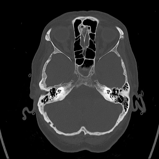 Cerebral venous infarction with hemorrhage (Radiopaedia 65343-74381 Axial bone window 26).jpg
