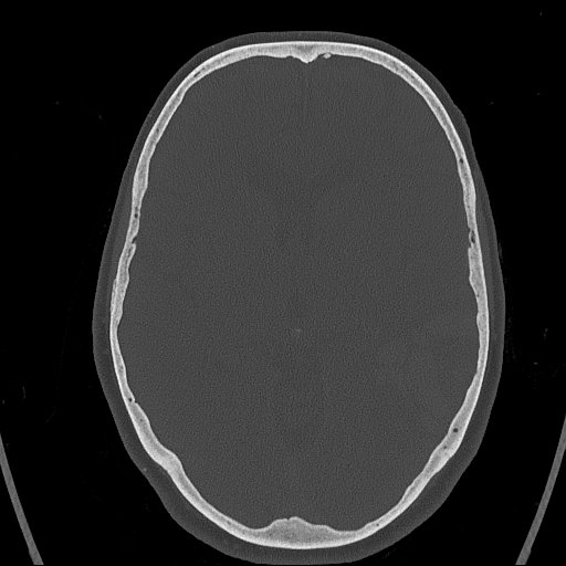 Cerebral venous infarction with hemorrhage (Radiopaedia 65343-74381 Axial bone window 82).jpg