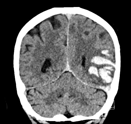 Cerebral venous infarction with hemorrhage (Radiopaedia 65343-74381 Coronal non-contrast 40).jpg