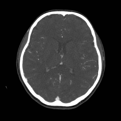 Cerebral venous sinus thrombosis (Radiopaedia 40619-43227 A 127).jpg