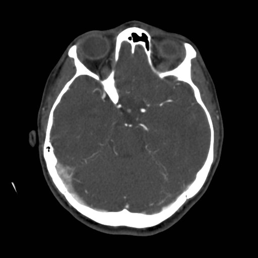 Cerebral venous sinus thrombosis (Radiopaedia 40619-43227 A 82).jpg