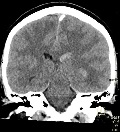 Cerebral venous sinus thrombosis (Radiopaedia 91329-108965 Coronal non-contrast 33).jpg