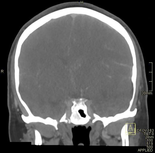 Cerebral venous sinus thrombosis (Radiopaedia 91329-108965 Coronal venogram 42).jpg