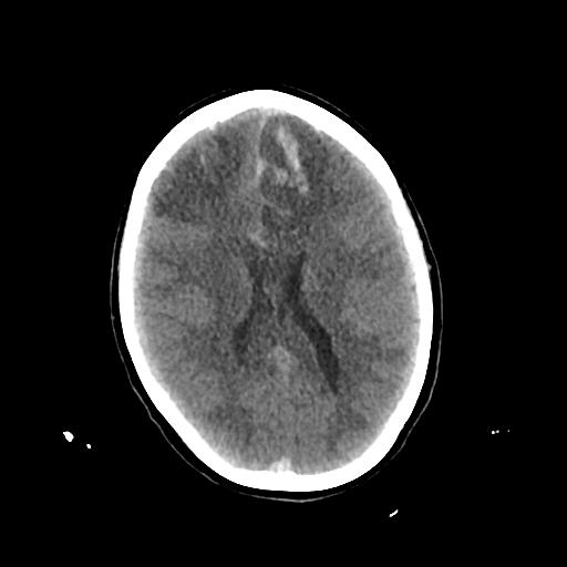File:Cerebral venous throbmosis - hemorrhagic venous infarction (Radiopaedia 87318-103613 Axial non-contrast 100).jpg