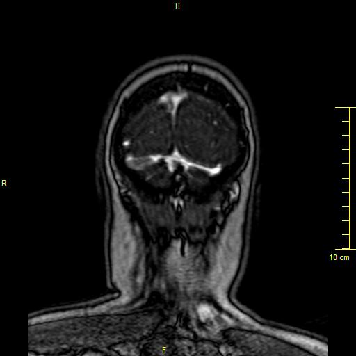 Cerebral venous thrombosis (Radiopaedia 23288-23351 MRV 166).JPG