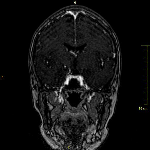 Cerebral venous thrombosis (Radiopaedia 23288-23351 MRV 62).JPG