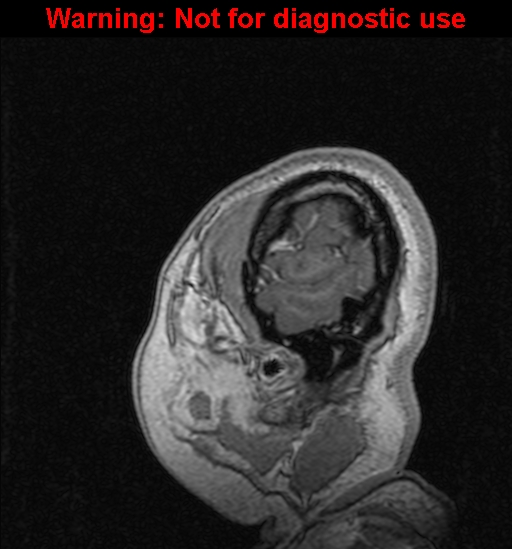 Cerebral venous thrombosis (Radiopaedia 37224-39208 Sagittal T1 C+ 141).jpg