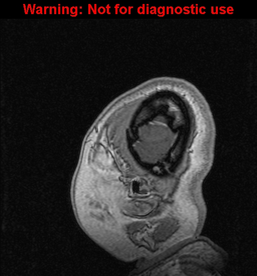 File:Cerebral venous thrombosis (Radiopaedia 37224-39208 Sagittal T1 C+ 144).jpg