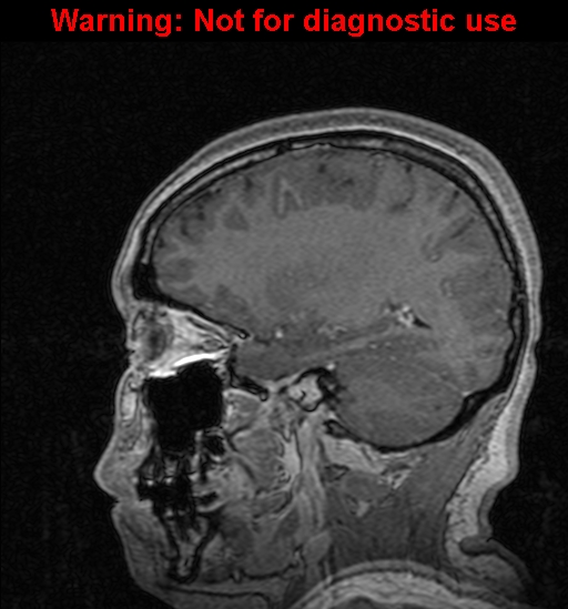 Cerebral venous thrombosis (Radiopaedia 37224-39208 Sagittal T1 C+ 53).jpg