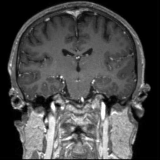 Cerebral venous thrombosis (Radiopaedia 38392-40469 Coronal T1 C+ 42).png