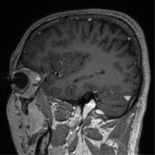 Cerebral venous thrombosis (Radiopaedia 38392-40469 Sagittal T1 C+ 64).png