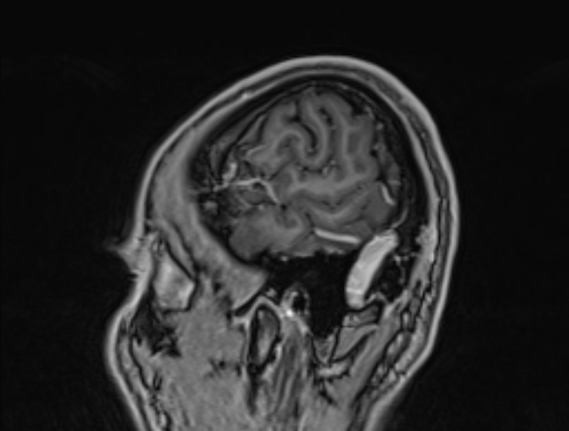 Cerebral venous thrombosis (Radiopaedia 71207-81504 Sagittal T1 C+ 4).jpg