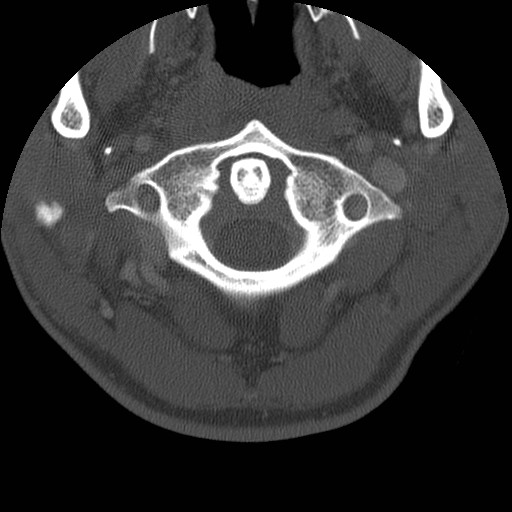 Cervical Pott disease (Radiopaedia 20374-20286 Axial bone window 23).jpg