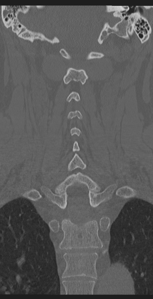 Cervical canal stenosis due to ossification of the posterior longitudinal ligament (Radiopaedia 47260-51823 Coronal bone window 39).png