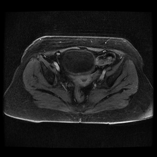 Cervical carcinoma (Radiopaedia 70924-81132 Axial T1 C+ fat sat 144).jpg