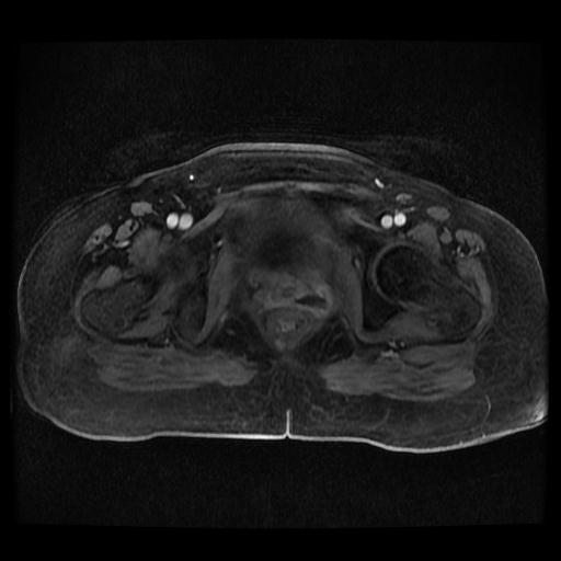 Cervical carcinoma (Radiopaedia 70924-81132 Axial T1 C+ fat sat 210).jpg