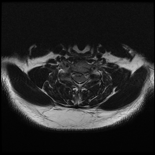 File:Cervical disc extrusion (Radiopaedia 59074-66364 Axial T2 11).jpg