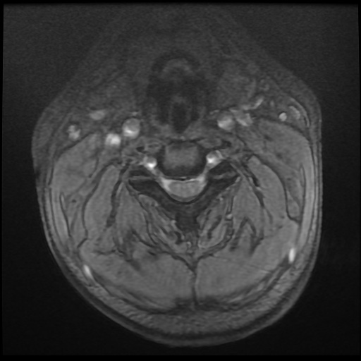 Cervical disc extrusion (Radiopaedia 59074-66364 F 7).jpg