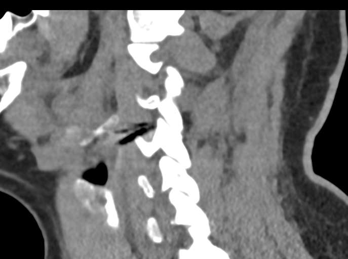 File:Cervical disc replacement (Radiopaedia 44025-47541 B 35).png