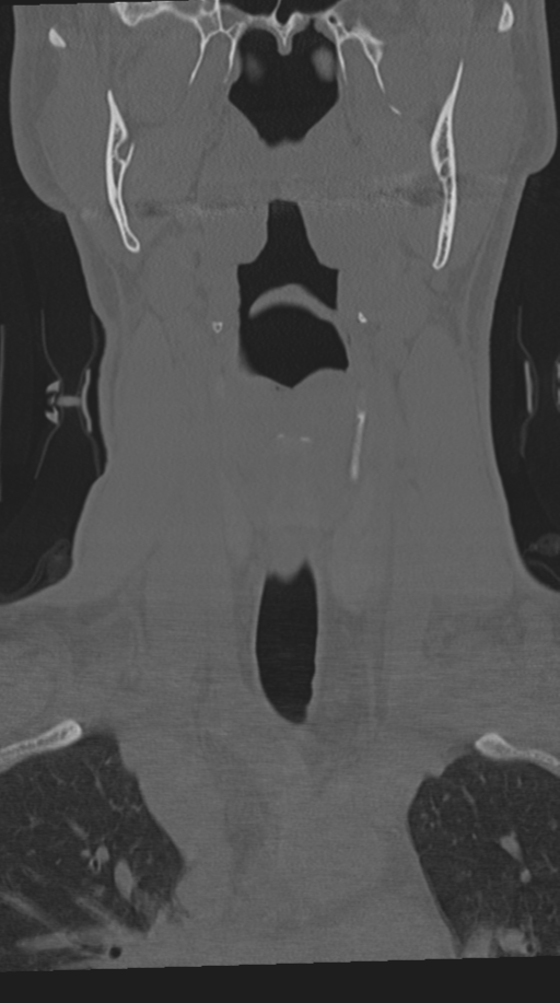 Cervical intercalary bone (Radiopaedia 35211-36748 Coronal bone window 18).png
